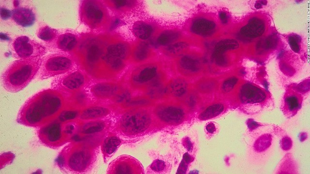 がん患者の腫瘍細胞に関する発見が、研究の突破口になった