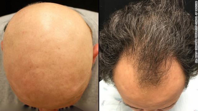 Cnn Co Jp 円形脱毛症の人に朗報 関節炎などの薬に効果か 米研究 1 3