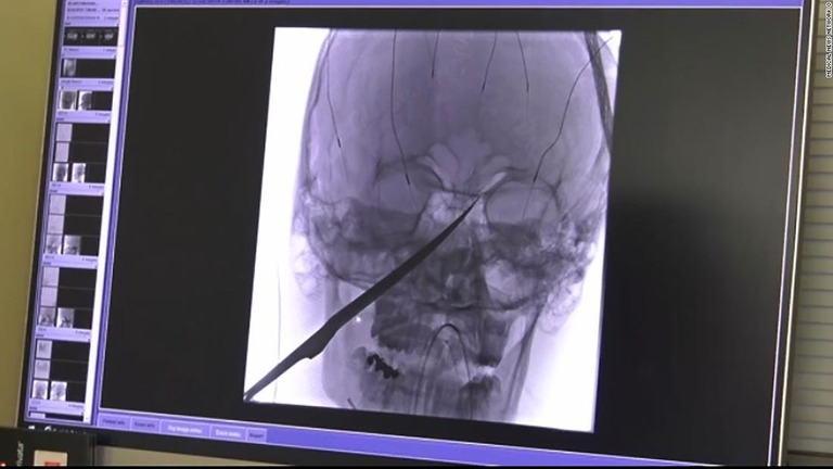 少年の顔面に２５センチの刃物が突き刺さる事故が起きたが手術で除去され事なきを得た/Medical News Network