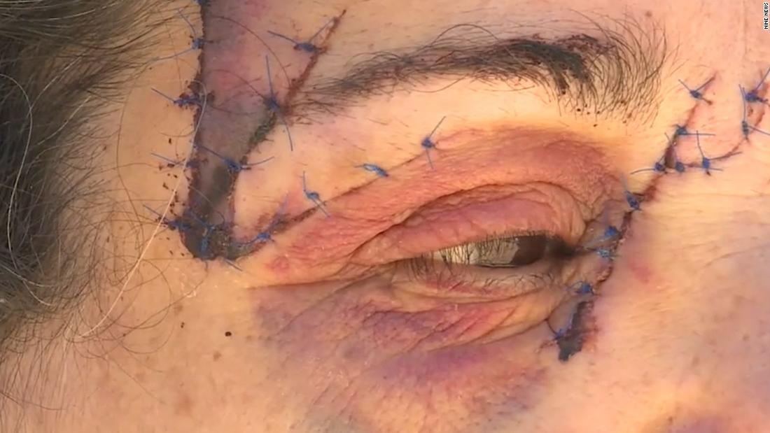 Cnn Co Jp 豪女性 遊歩道でカンガルーに襲われ大けが 顔を２５針縫う