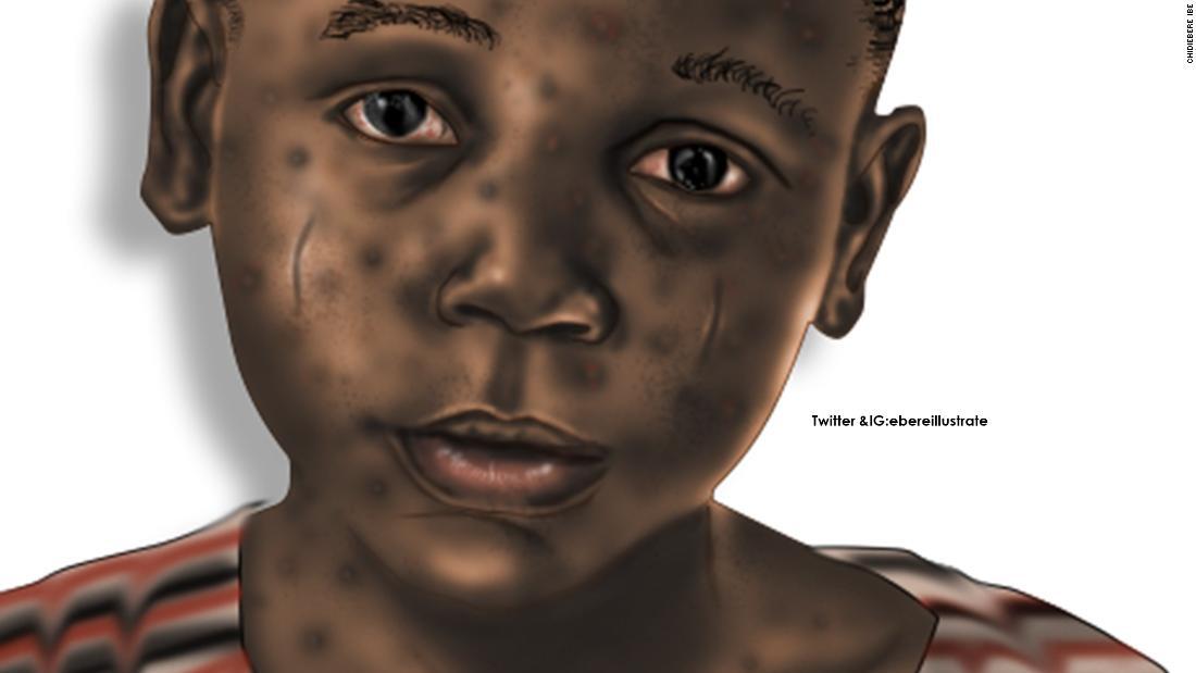 黒人の胎児を描いた医学イラストが拡散 書籍に掲載される運びに 1 3 Cnn Co Jp