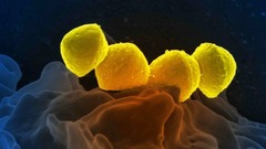 劇症型溶血性レンサ球菌感染症、報告数が過去最多に　日本