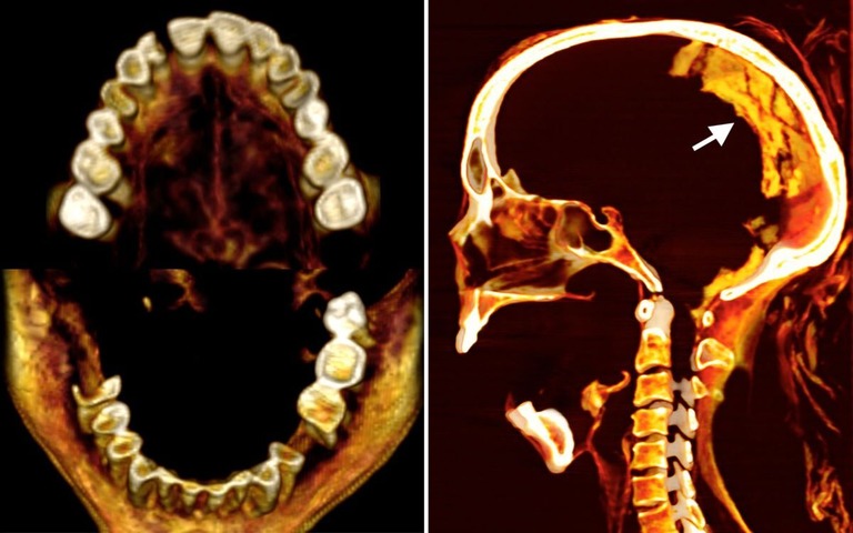 ミイラの歯と脳のＣＴ画像/Sahar Saleem via CNN Newsource