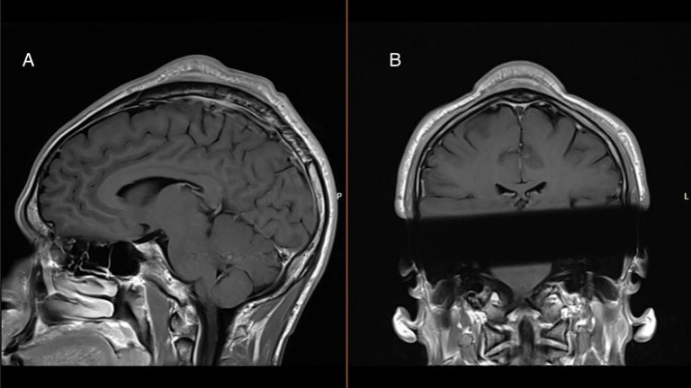 頭皮の腫瘍を報告したブレークダンサーの頭部のＭＲＩ画像/BMJ Case Reports 2024